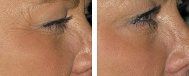 BOTOX® Cosmetic: Before & After