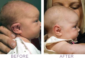 EarWell™ Infant Ear Correction System: Before & After