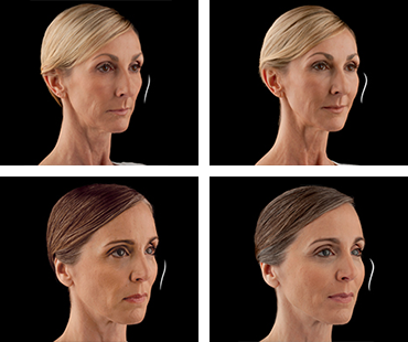 JUVÉDERM VOLUMA™ XC: Before & After