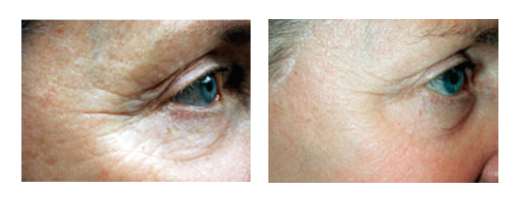 Dermapen_before_after