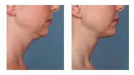 Kybella